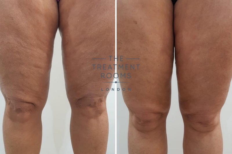 Thigh thread lift
